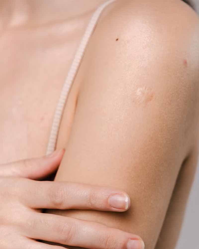 Miglioramento delle Cicatrici