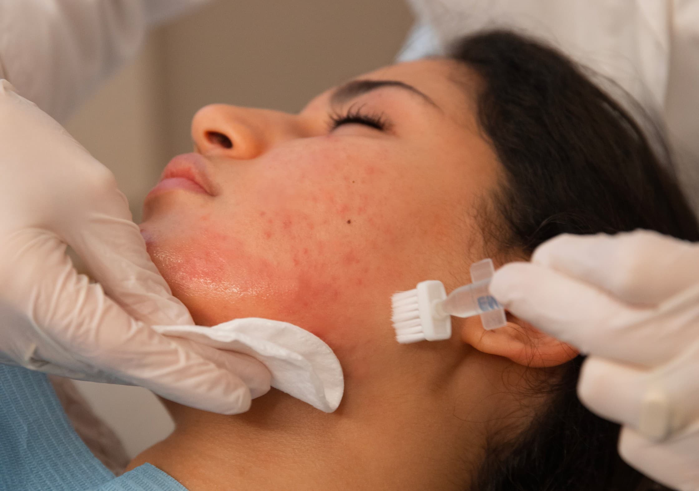 togliere-acne-attiva